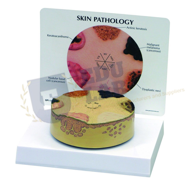 Skin Cancer Model