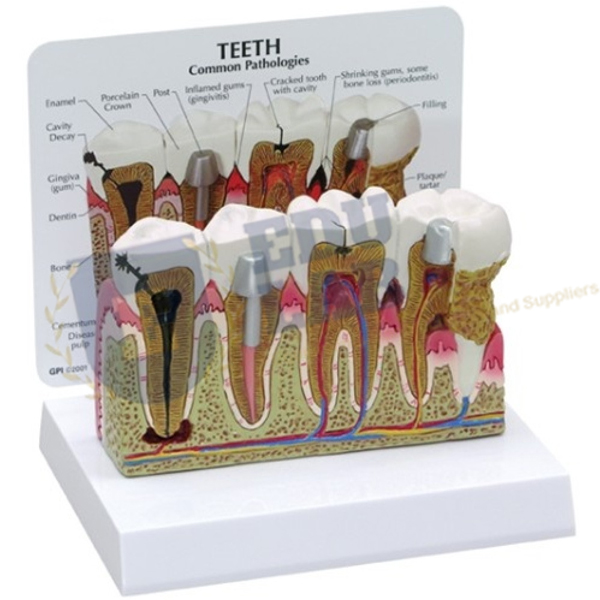 Human Teeth Model - Dental Problems