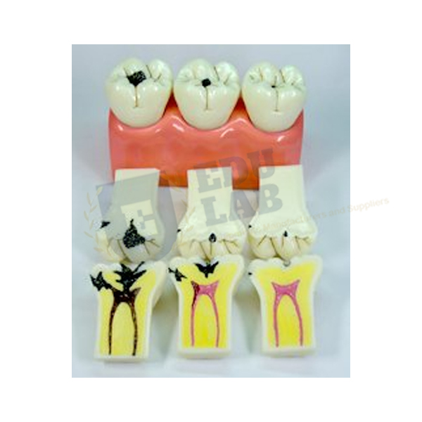Dental Caries Model